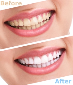 Teeth-Whitening-fremont-dentist-jaspreet-harika-dds