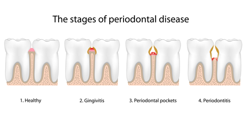 periodontal gingivitis disease gum stages periodontitis tooth cleaning dental receding gums deep treatment causes teeth diagram loss decay different dr